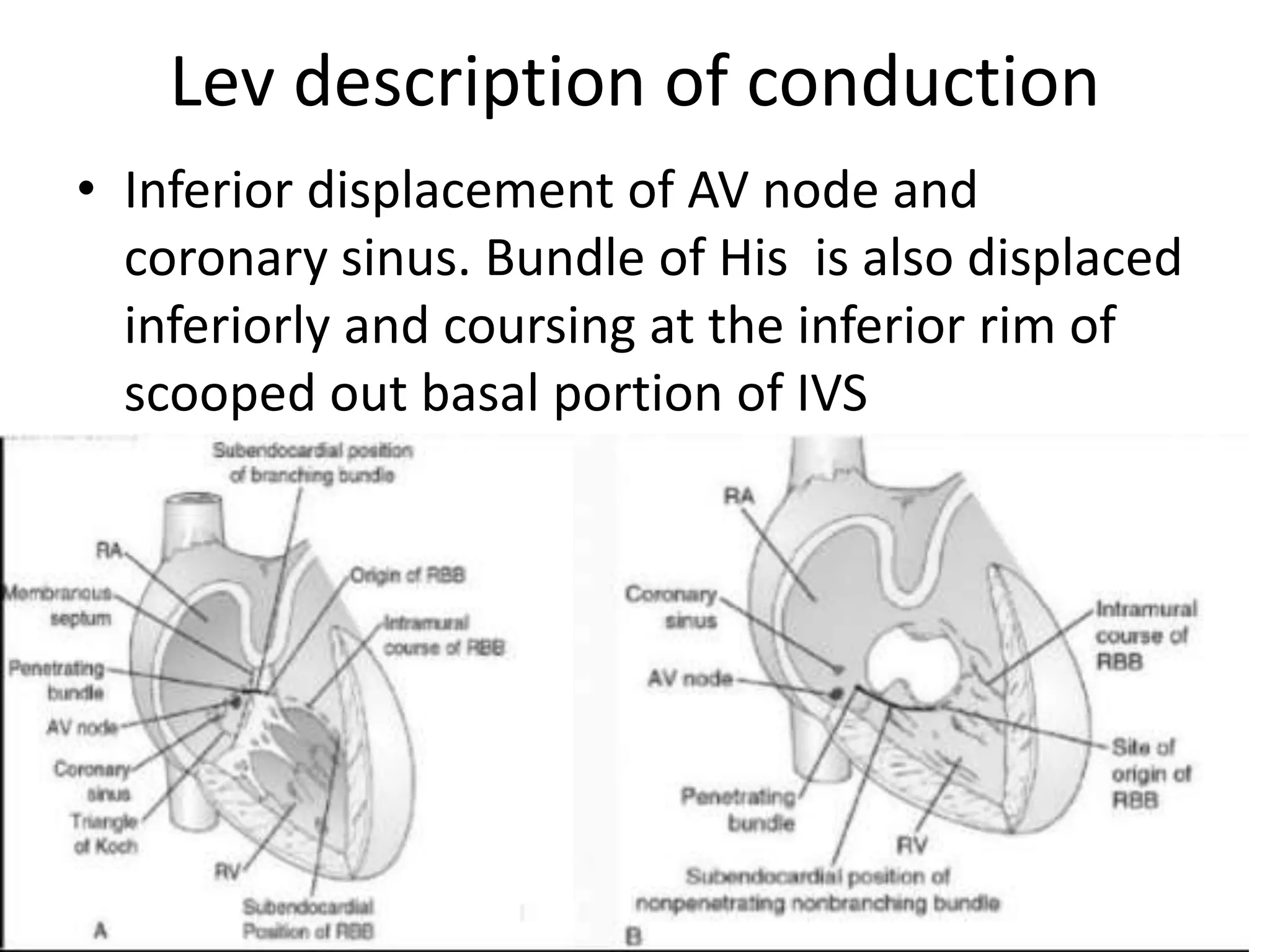 Lev description of conduction
• Inferior displacement of AV node and
coronary sinus. Bundle of His is also displaced
inferiorly and coursing at the inferior rim of
scooped out basal portion of IVS
 