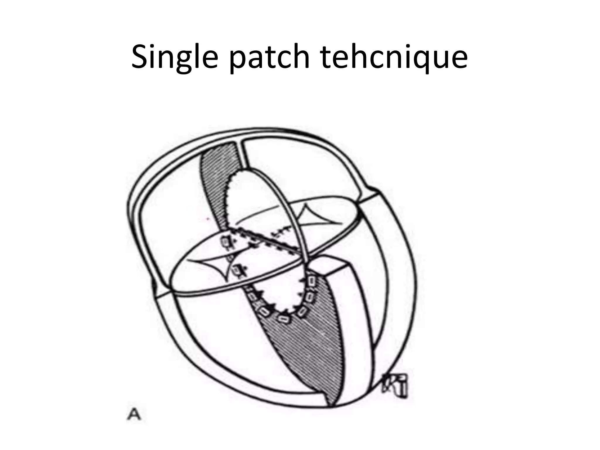 Single patch tehcnique
 