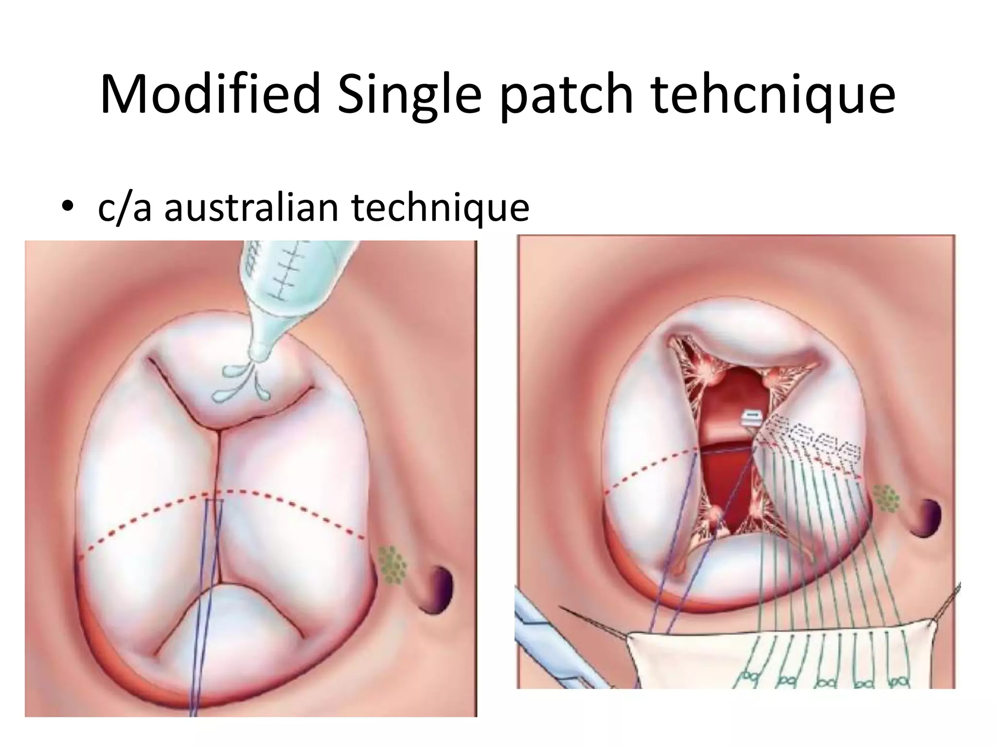 Modified Single patch tehcnique
• c/a australian technique
 