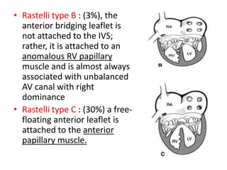 Atrioventricular canal defect | PPTX
