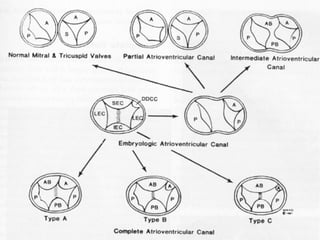 Atrioventricular canal defect, Firas Aljanadi,MD | PPT