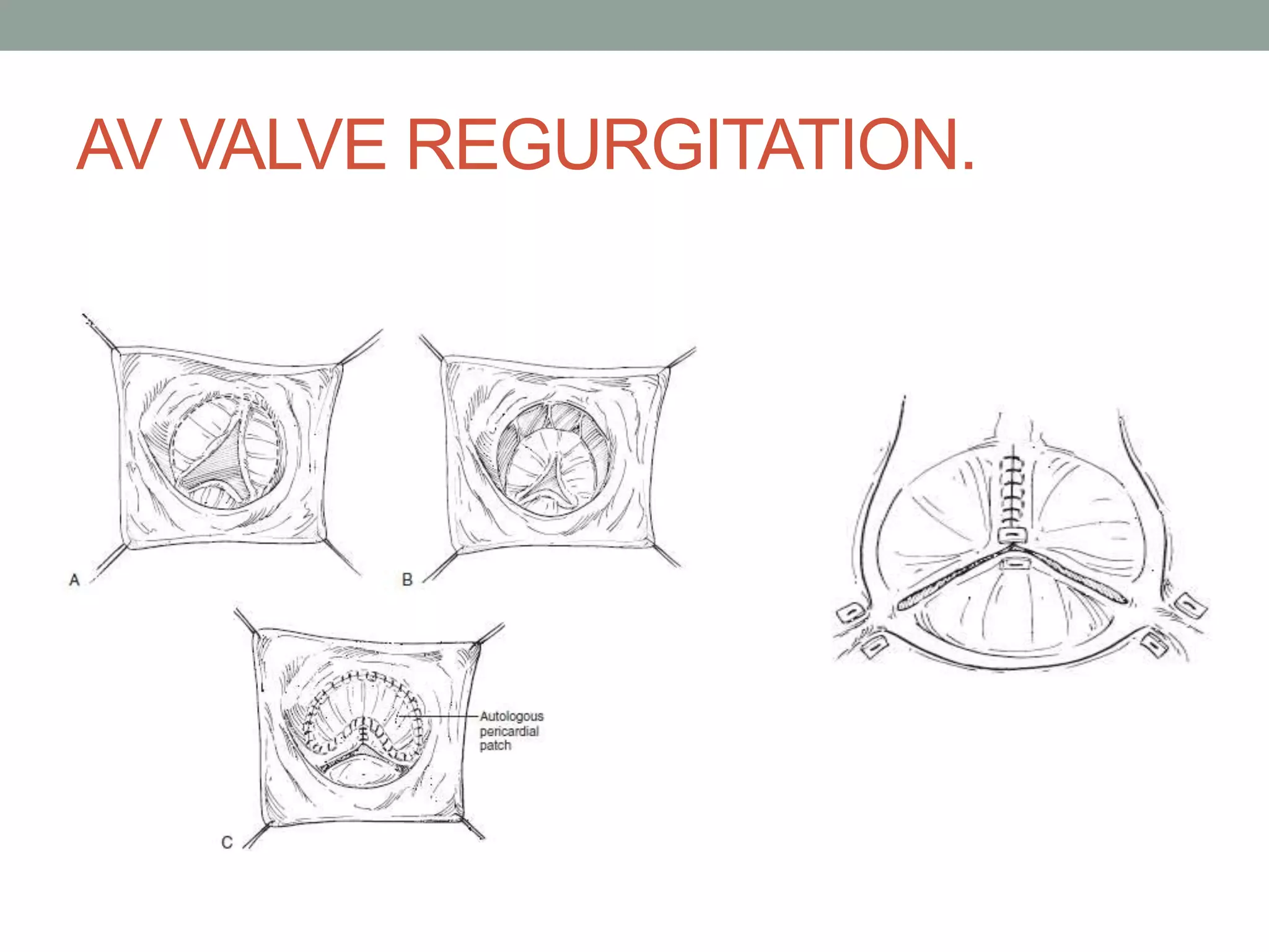 Atrioventricular septal defects | PPTX