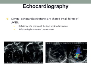 Avsd Wave Atrioventricular septal defects | PPTX