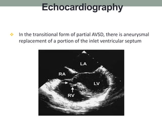 Avsd Wave Atrioventricular septal defects | PPTX