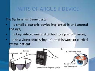 PARTS OF ARGUS II DEVICE
The System has three parts:
• a small electronic device implanted in and around
the eye,
• a tiny video camera attached to a pair of glasses,
• and a video processing unit that is worn or carried
by the patient.
 