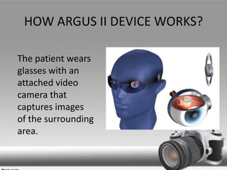 HOW ARGUS II DEVICE WORKS?
The patient wears
glasses with an
attached video
camera that
captures images
of the surrounding
area.
 