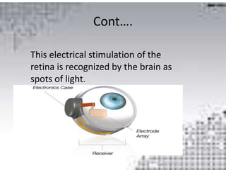 Cont….
This electrical stimulation of the
retina is recognized by the brain as
spots of light.
 