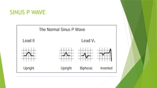 Right and left atrial enlargement in ecg | PPTX