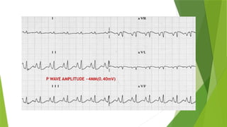 Right and left atrial enlargement in ecg | PPTX