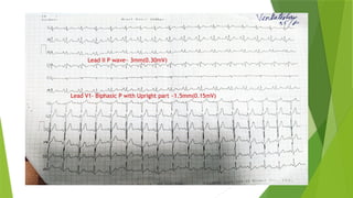 Right and left atrial enlargement in ecg | PPTX