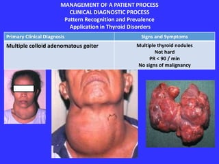MANAGEMENT OF A PATIENT PROCESS
CLINICAL DIAGNOSTIC PROCESS
Pattern Recognition and Prevalence
Application in Thyroid Disorders
Primary Clinical Diagnosis Signs and Symptoms
Multiple colloid adenomatous goiter Multiple thyroid nodules
Not hard
PR < 90 / min
No signs of malignancy
 