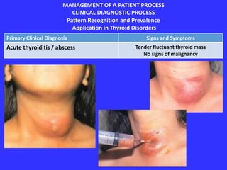 MANAGEMENT OF A PATIENT PROCESS
CLINICAL DIAGNOSTIC PROCESS
Pattern Recognition and Prevalence
Application in Thyroid Disorders
Primary Clinical Diagnosis Signs and Symptoms
Acute thyroiditis / abscess Tender fluctuant thyroid mass
No signs of malignancy
 