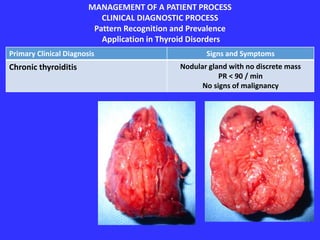 MANAGEMENT OF A PATIENT PROCESS
CLINICAL DIAGNOSTIC PROCESS
Pattern Recognition and Prevalence
Application in Thyroid Disorders
Primary Clinical Diagnosis Signs and Symptoms
Chronic thyroiditis Nodular gland with no discrete mass
PR < 90 / min
No signs of malignancy
 