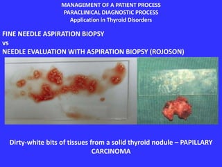 MANAGEMENT OF A PATIENT PROCESS
PARACLINICAL DIAGNOSTIC PROCESS
Application in Thyroid Disorders
FINE NEEDLE ASPIRATION BIOPSY
vs
NEEDLE EVALUATION WITH ASPIRATION BIOPSY (ROJOSON)
Dirty-white bits of tissues from a solid thyroid nodule – PAPILLARY
CARCINOMA
 