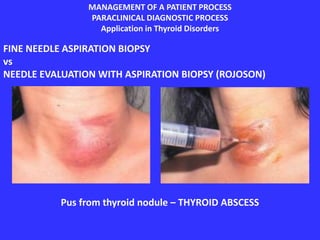 MANAGEMENT OF A PATIENT PROCESS
PARACLINICAL DIAGNOSTIC PROCESS
Application in Thyroid Disorders
FINE NEEDLE ASPIRATION BIOPSY
vs
NEEDLE EVALUATION WITH ASPIRATION BIOPSY (ROJOSON)
Pus from thyroid nodule – THYROID ABSCESS
 