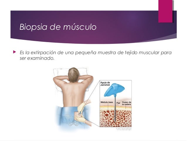 En Que Consiste La Distrofia Muscular