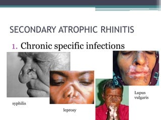 SECONDARY ATROPHIC RHINITIS
1. Chronic specific infections

Lupus
vulgaris
syphilis
leprosy

 