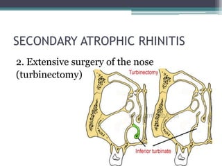 SECONDARY ATROPHIC RHINITIS
2. Extensive surgery of the nose
(turbinectomy)

 