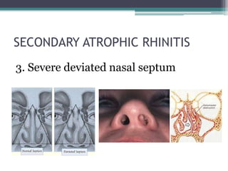 SECONDARY ATROPHIC RHINITIS
3. Severe deviated nasal septum

 