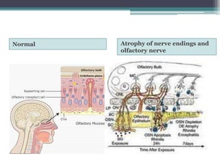 Normal

Atrophy of nerve endings and
olfactory nerve

 