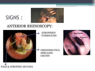 SIGNS :
ANTERIOR RHINOSCOPY:
ATROPHIED
TURBINATES

GREENISH FOUL
SMELLING
CRUSTS

PALE & ATROPHIC MUCOSA

 