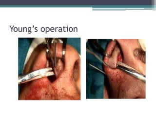Young’s operation

 