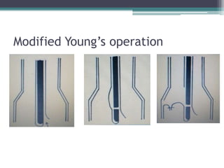 Modified Young’s operation

 