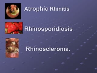 Atrophic Rhinitis 
Rhinosporidiosis 
Rhinoscleroma. 
 