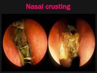 Nasal crusting
 