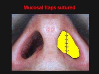 Mucosal flaps sutured
 