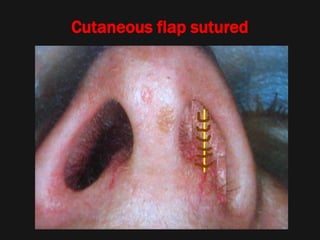 Cutaneous flap sutured
 