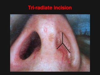 Tri-radiate incision
 
