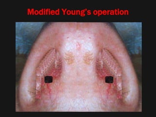 Modified Young’s operation
 