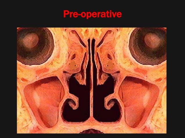 Atrophic rhinitis | PPT