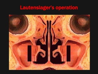Lautenslager’s operation
 