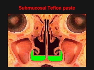 Submucosal Teflon paste
 