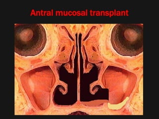 Antral mucosal transplant
 