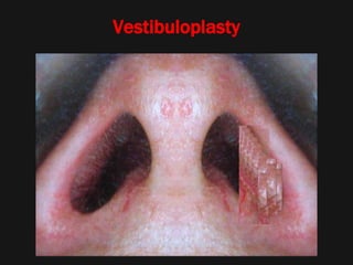 Vestibuloplasty
 