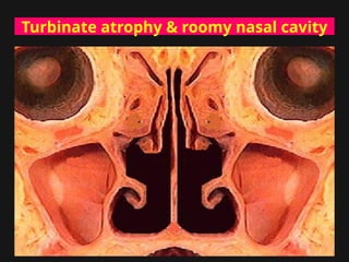 Turbinate atrophy & roomy nasal cavity
 