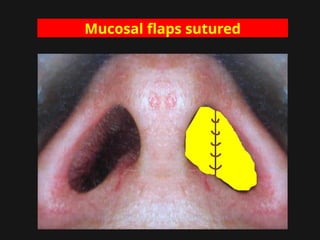 Mucosal flaps sutured
 