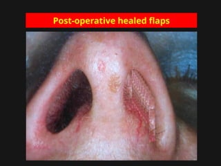 Post-operative healed flaps
 