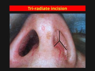 Tri-radiate incision
 