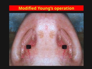 Modified Young’s operation
 