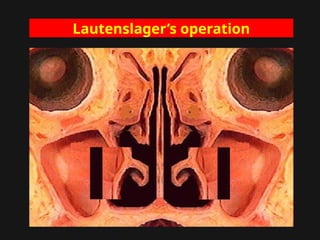 Lautenslager’s operation
 