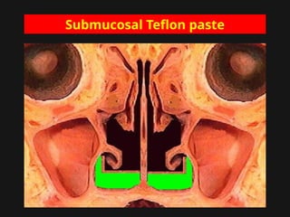 Submucosal Teflon paste
 