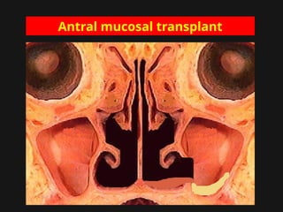 Antral mucosal transplant
 