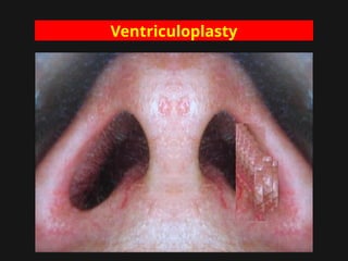 Ventriculoplasty
 