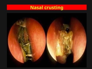 Nasal crusting
 