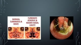 ATROPHIC RHINITIS.pptx/rhinitis/atrophic | PPTX