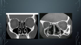 ATROPHIC RHINITIS.pptx/rhinitis/atrophic | PPTX
